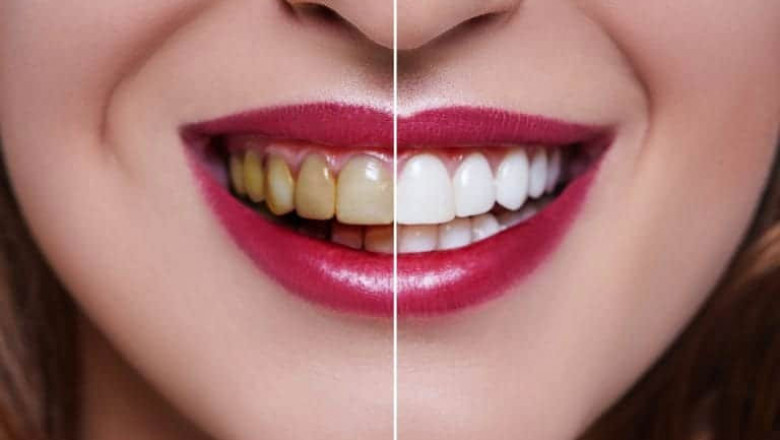 Make a Brilliant First Impression with a Whiter Smile