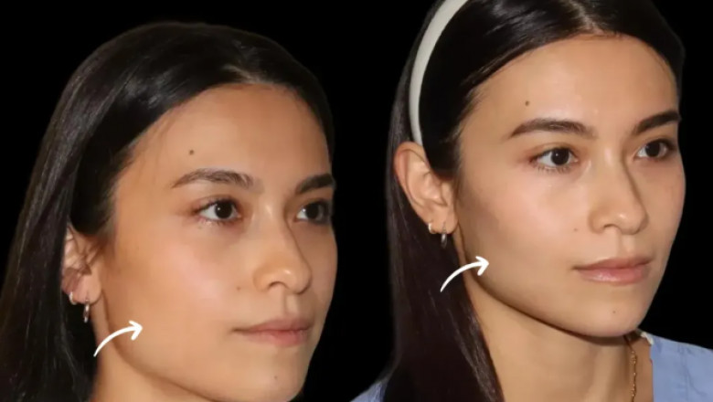 When to Touch Up: Best Plastic Surgeons in Dubai Recommend Timelines for Sculptra Fillers