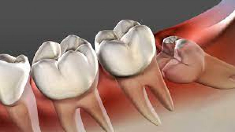 Why Tooth Removals Vary in Price (and What’s Fair)