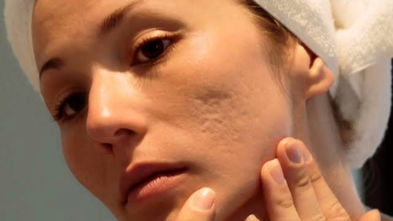 Acne Scars on Cheeks: Top Islamabad Solutions
