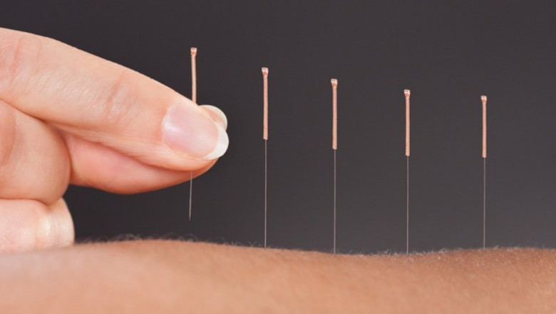 Acupuncture