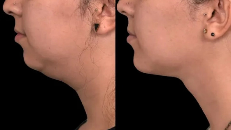 How to Avoid Scarring from Double chin removal in Dubai