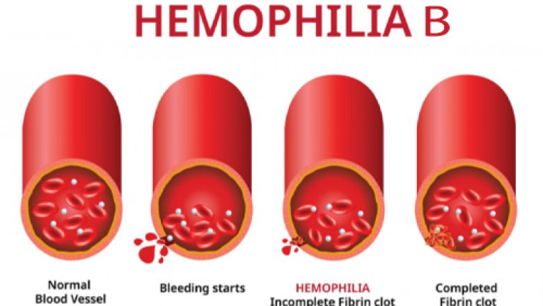 The Evolving Hemophilia B Market: Gene Therapy Revolution and Emerging Treatment Paradigms