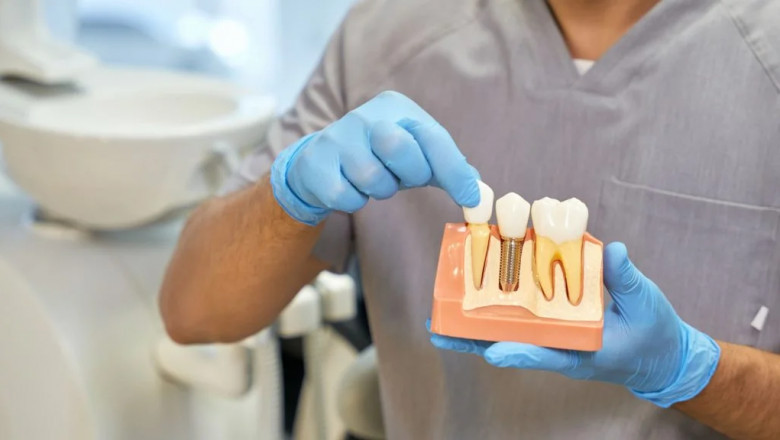 Why Dental Implants in Dubai Are a Long-Term Solution for Missing Teeth