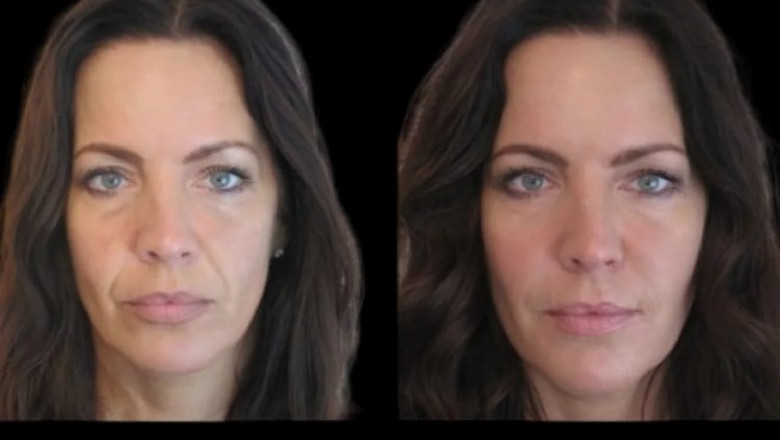 Achieve a Defined Jawline with Jawline Fillers Treatment in Dubai