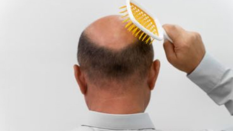 Before & After: Work of the Best Hair Transplant Specialist