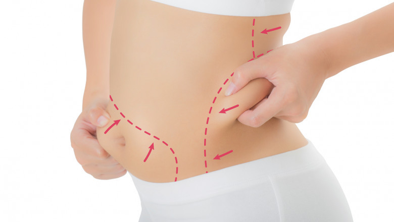 How Liposuction Delivers Fast Body Contouring Without the Strain