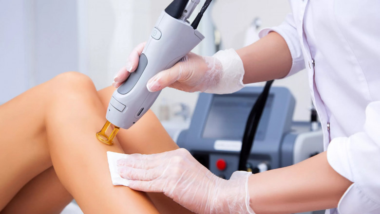 How Permanent Is Electrolysis Laser Hair Removal?