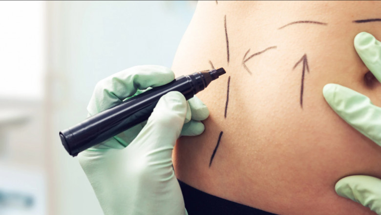 Liposuction Role in Confidence Revival Across Dubai