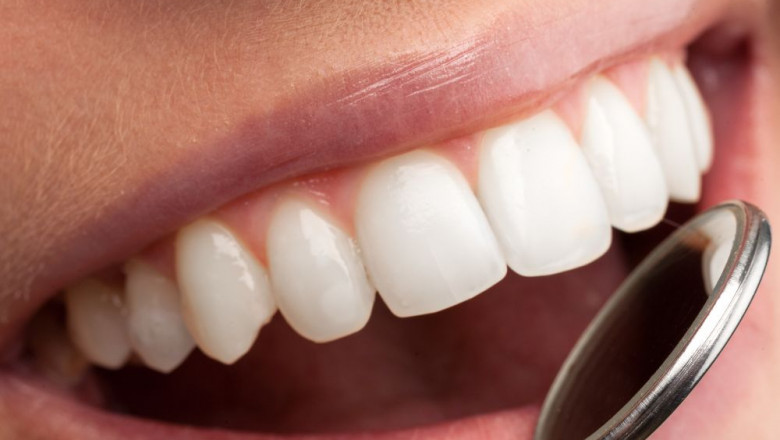Tooth Crowns in Dubai: Everything You Need to Know