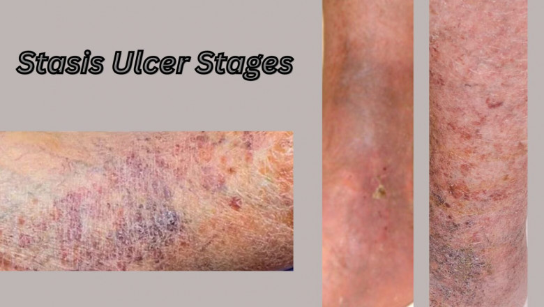 Understanding Stasis Ulcer Stages: Causes, Progression and Treatment