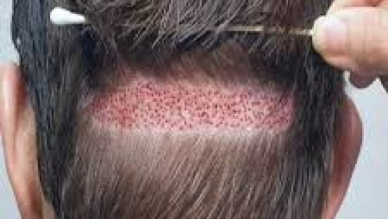 زراعة الشعر