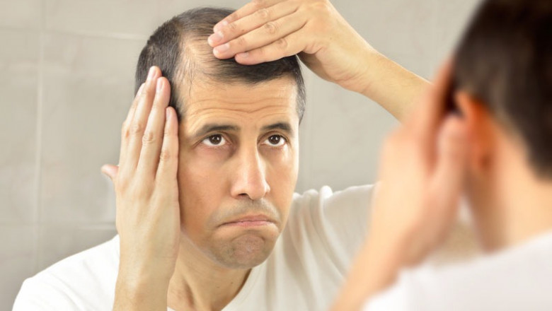 Alopecia and Hair Loss: Diagnosis, Care, and Advanced Treatment Options Available in Delhi