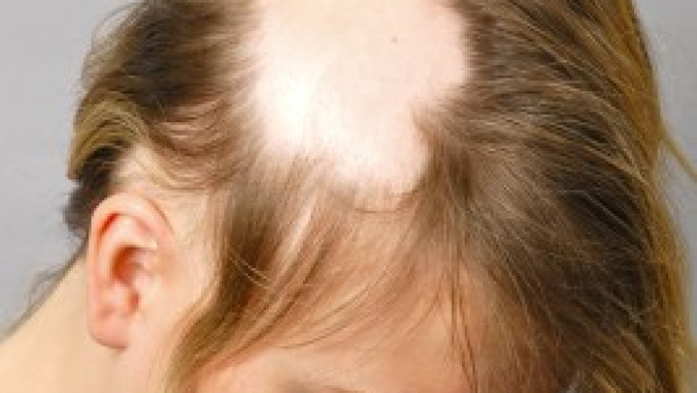Alopecia Areata Treatment | Hair Loss Treatment Philadelphia