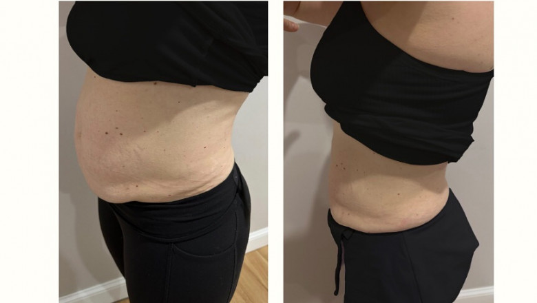 Body Contouring Newton