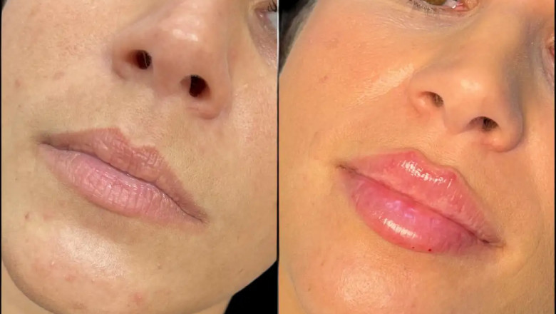 Fillers Treatments in Dubai for Natural-Looking Results