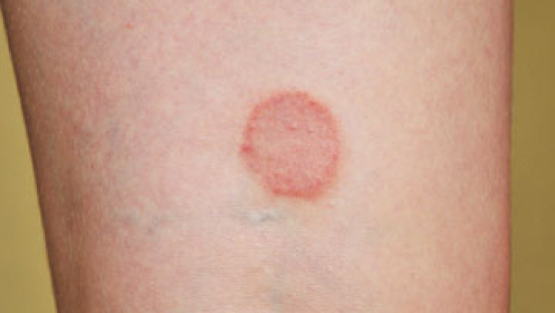 Lichen Planus Market Anticipated to Grow Owing to Rising Disease Prevalence