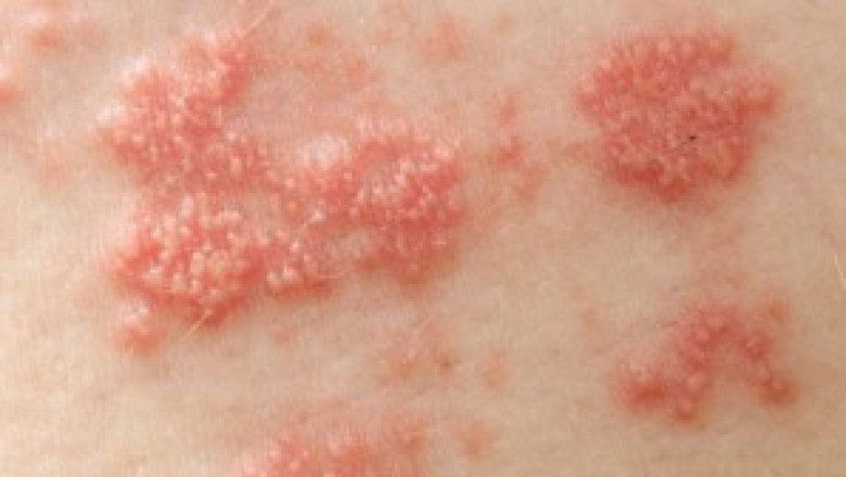 Shingles Treatment Philadelphia | Shingles Symptoms - Dr. Victor