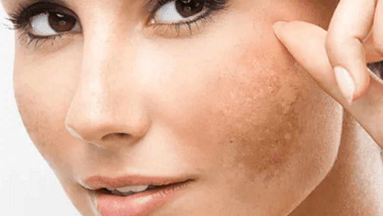 Skin Transformation Starts with Melasma Treatment