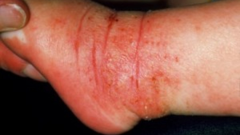 Symptoms of Dermatitis | Dermatitis Treatment Philadelphia