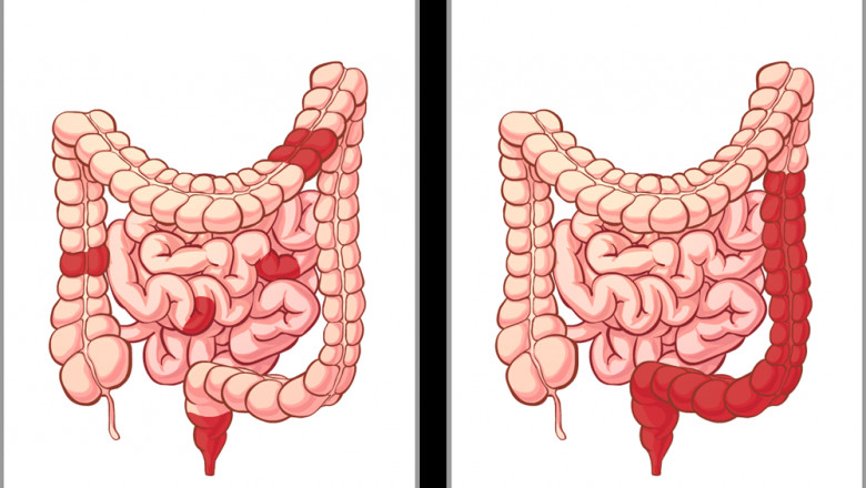 Treatment for IBD - Philadelphia Holistic Clinic - Dr. Tsan &amp; Assoc.