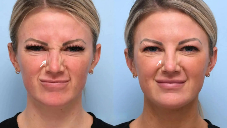 Best Doctors in Dubai for Botox: Common Myths and Facts You Should Know