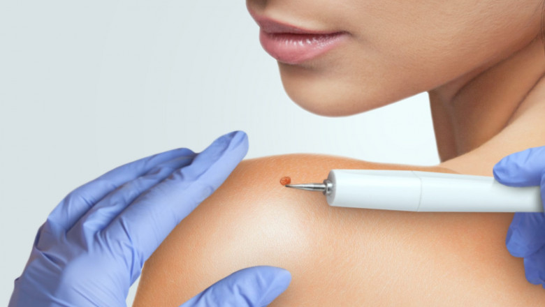 Can skin wart removal cost vary by treatment method?