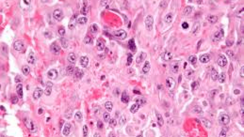 Epithelioid Sarcoma Market Size and Growth Prospects