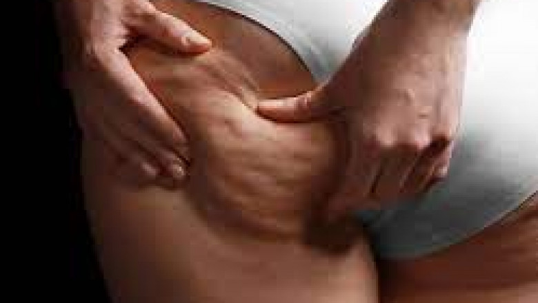 How Often Should I Get Cellulite Treatments?