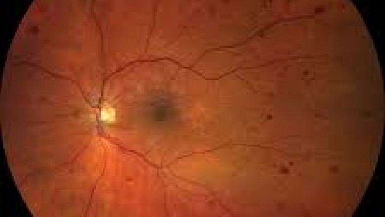 Proliferative Diabetic Retinopathy Market Grows on Diabetes Surge