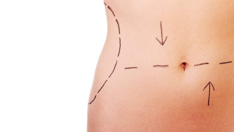 Ramadan Preparation and Tummy Tuck in Islamabad