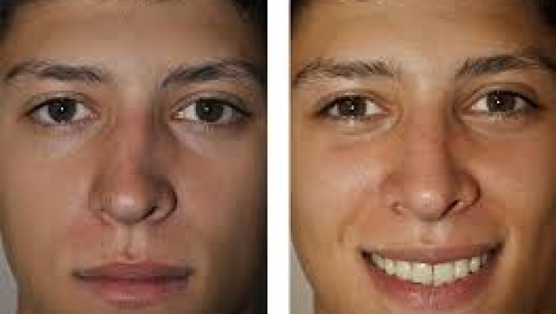 Santa Monica’s Trusted ENT Clinics for Balloon Sinuplasty