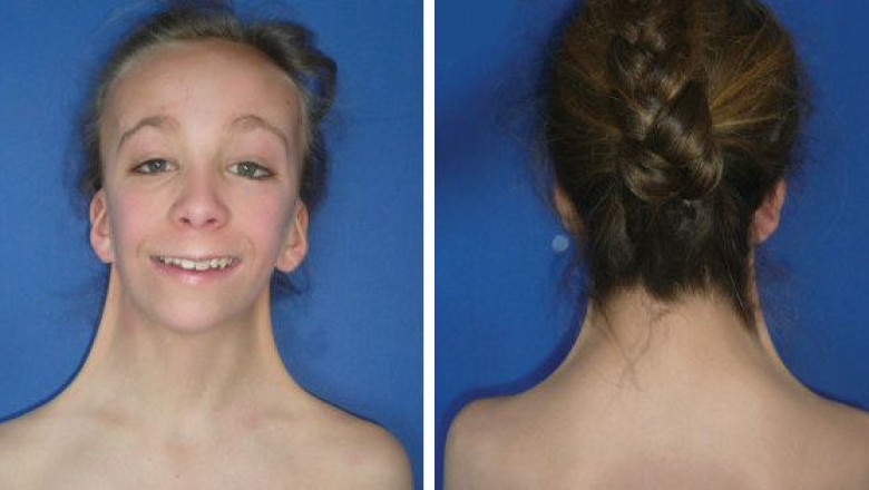 Turner Syndrome Market is Anticipated to Witness High Growth Owing to Rising Demand for Personalized Therapies