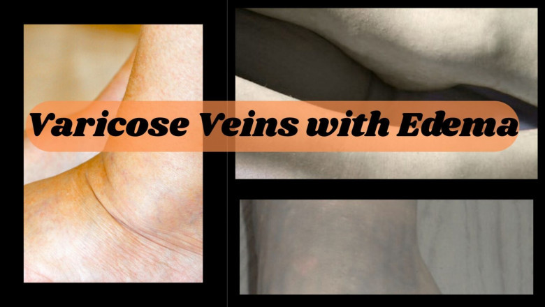 Varicose Veins with Edema: Symptoms, Causes and Management