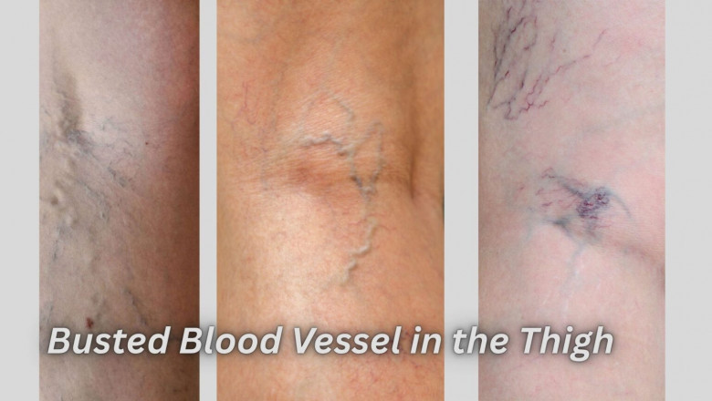 Busted Blood Vessel in the Thigh: Causes, Symptoms and Treatment