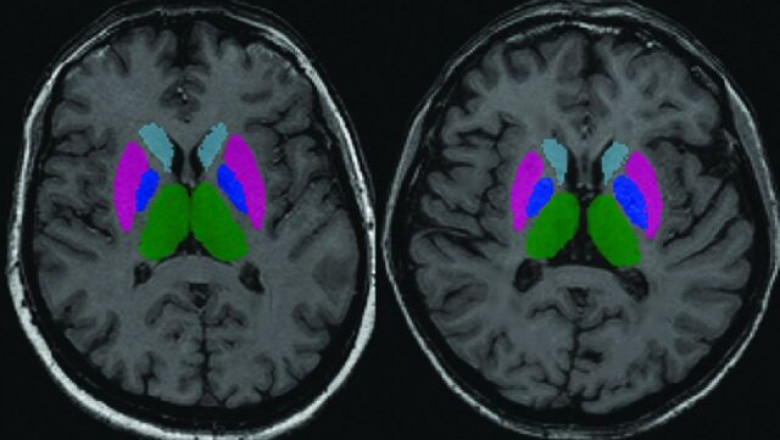 Clinically Isolated Syndrome Market Growth and Forecast Insights