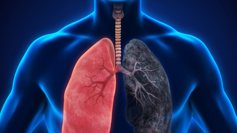 COPD Diagnosis Market Growth and Forecast 2032