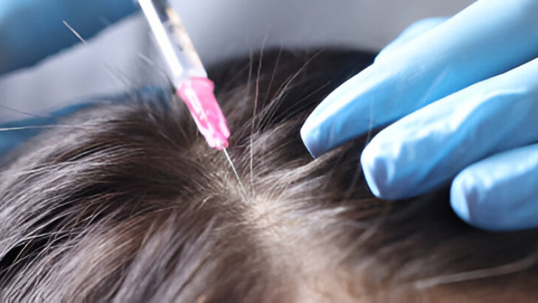 How Bio FUE Hair Transplant is Changing the Future of Hair Restoration