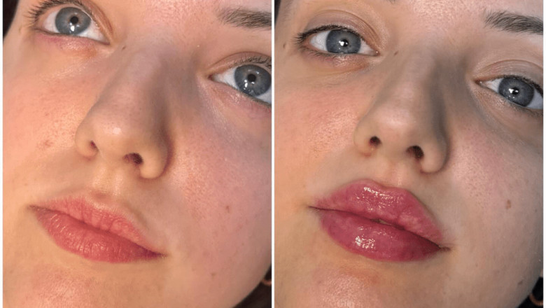 The Best Doctors in Dubai Reveal How Juvederm Boosts Confidence