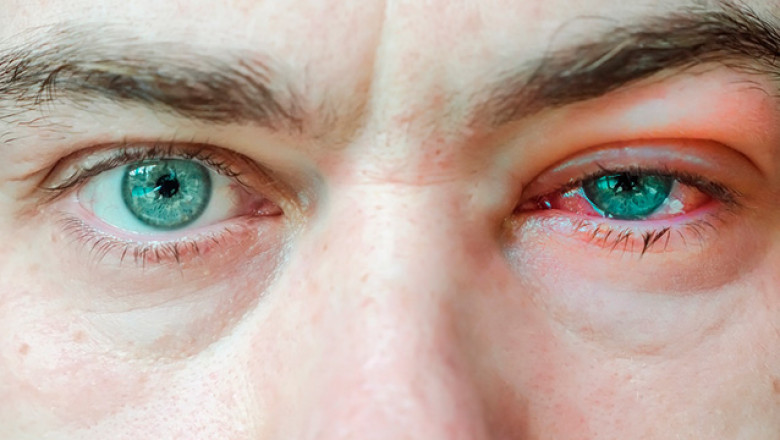 Viral Conjunctivitis Drugs Market: Growth, Segments &amp; Strategies