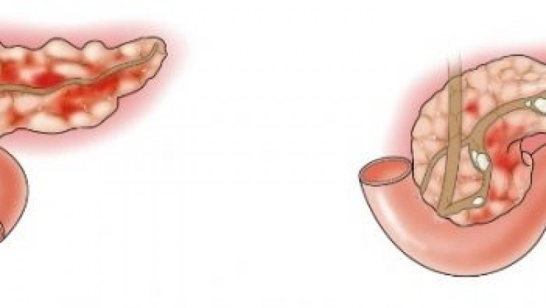 Acute Pancreatitis Market Growth and Opportunity Overview