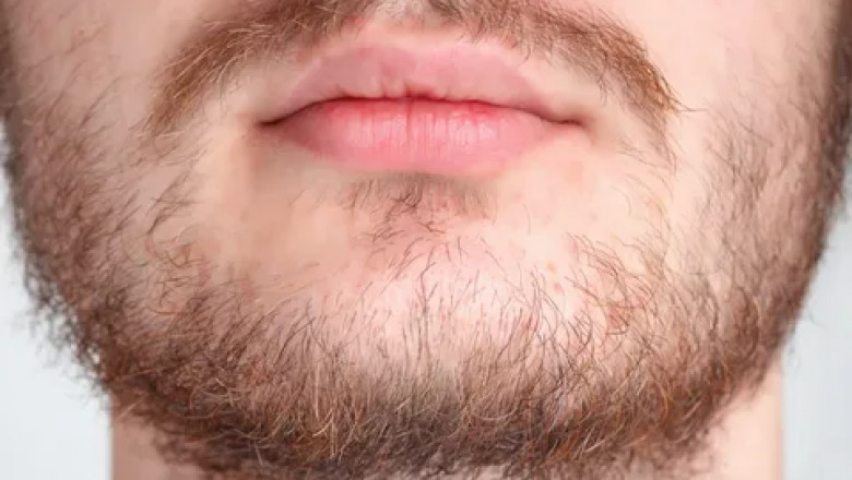 Beard Hair Transplant: Your Ultimate Guide