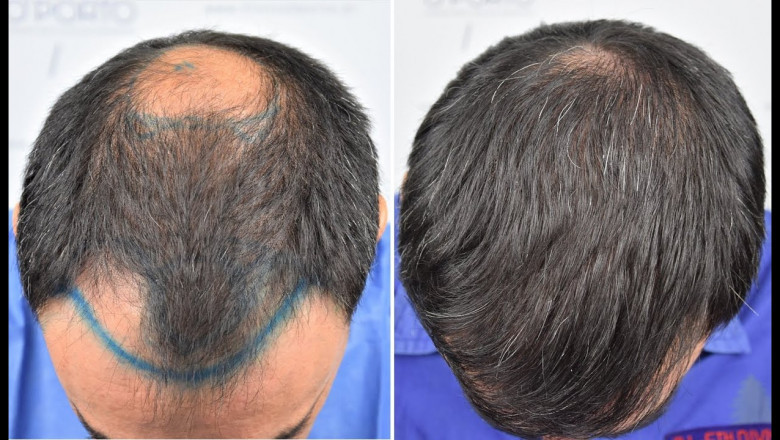 I Got My Crown Hair Transplant in Islamabad – Here's What Happened