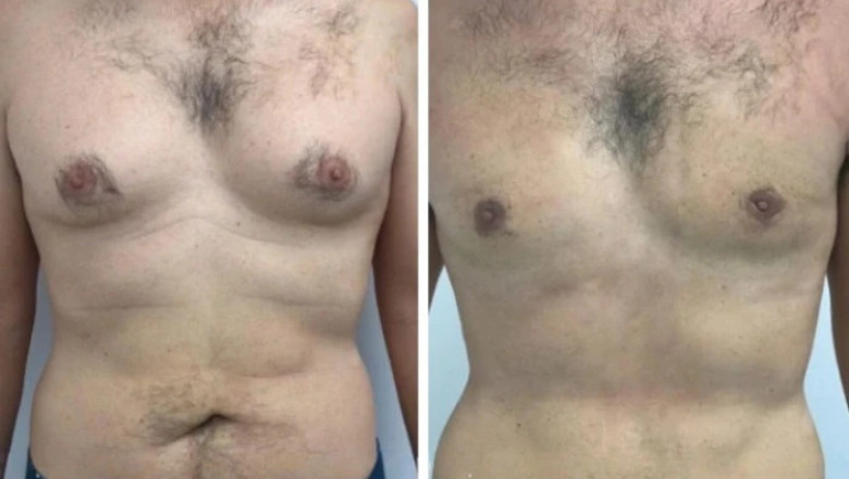 What to Expect During Your Recovery with the Best Doctors in Dubai for Gynecomastia Surgery