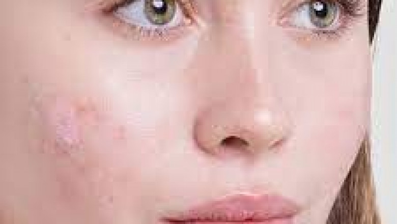Is Chemical Peeling Safe for Acne Scar Removal?