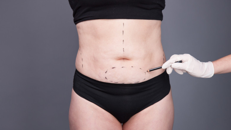 Minimally Invasive Liposuction Surgery Options