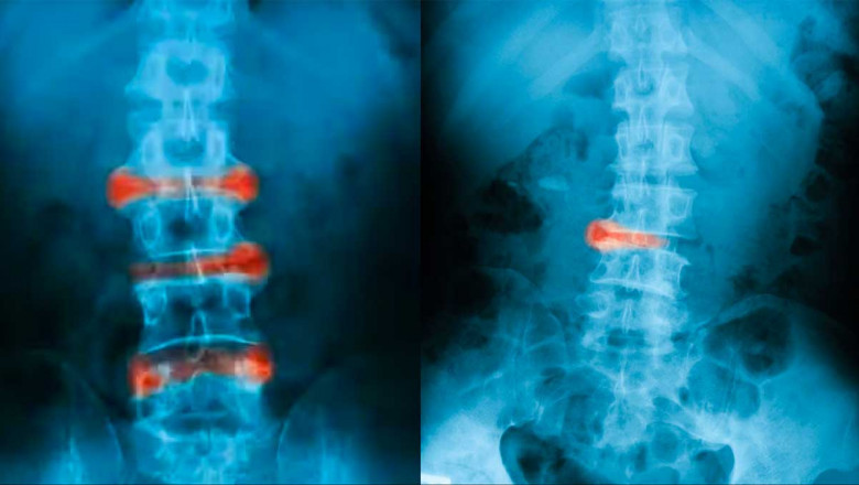 Axial Spondyloarthritis Treatment Market Growth & Trends