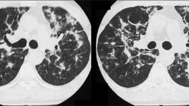 Bronchiolitis Obliterans Syndrome Market Size and Forecast