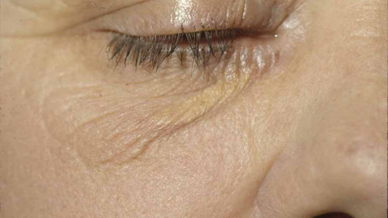 Cerebrotendinous Xanthomatosis Market: Global Trends and Forecast