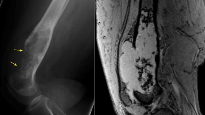 Chondrosarcoma Market Trends and Growth Outlook 2025–2032